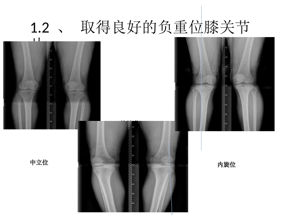 截骨术前 设计_第5页