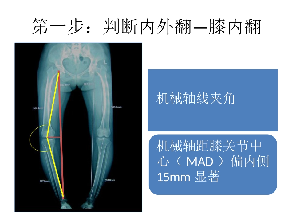 截骨术前 设计_第8页
