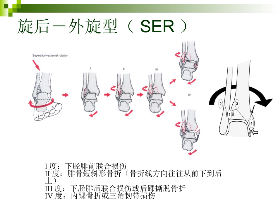 踝关节骨折的分类 和手术治疗_第10页