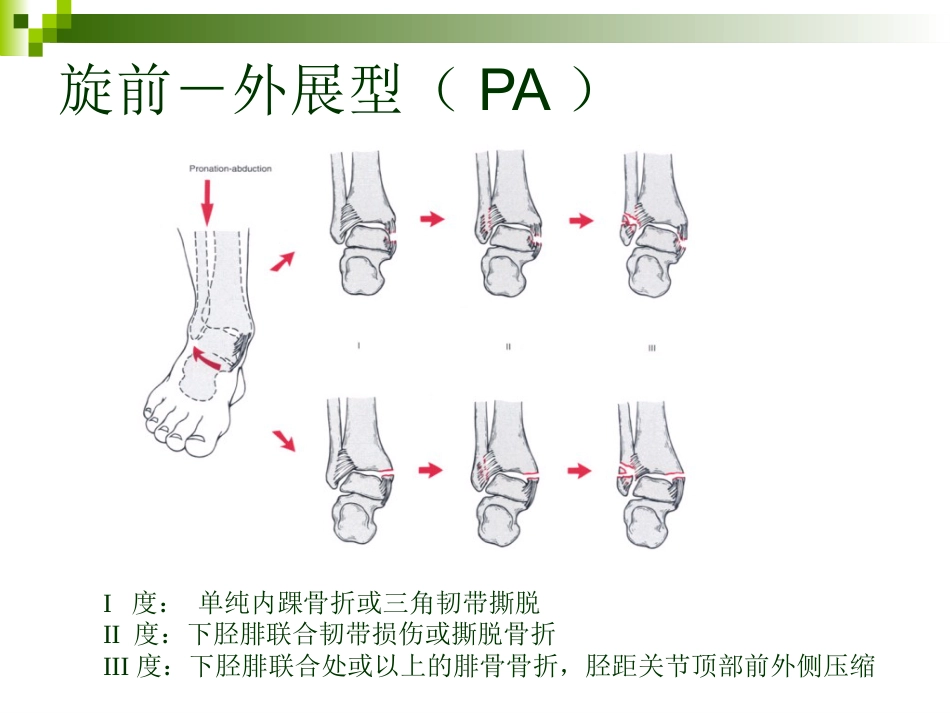 踝关节骨折的分类 和手术治疗_第13页