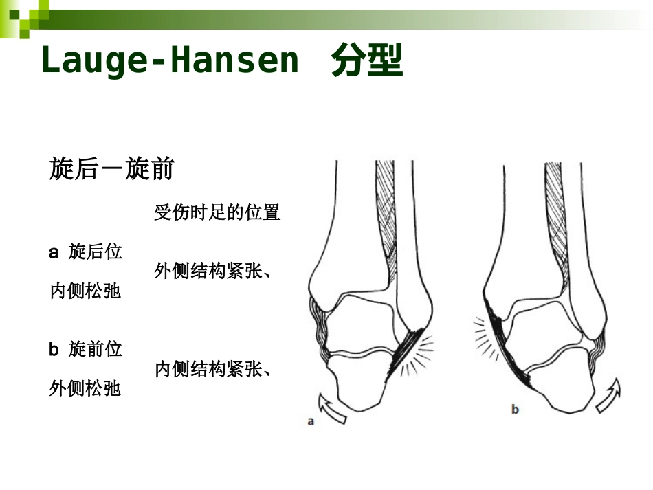 踝关节骨折的分类 和手术治疗_第4页