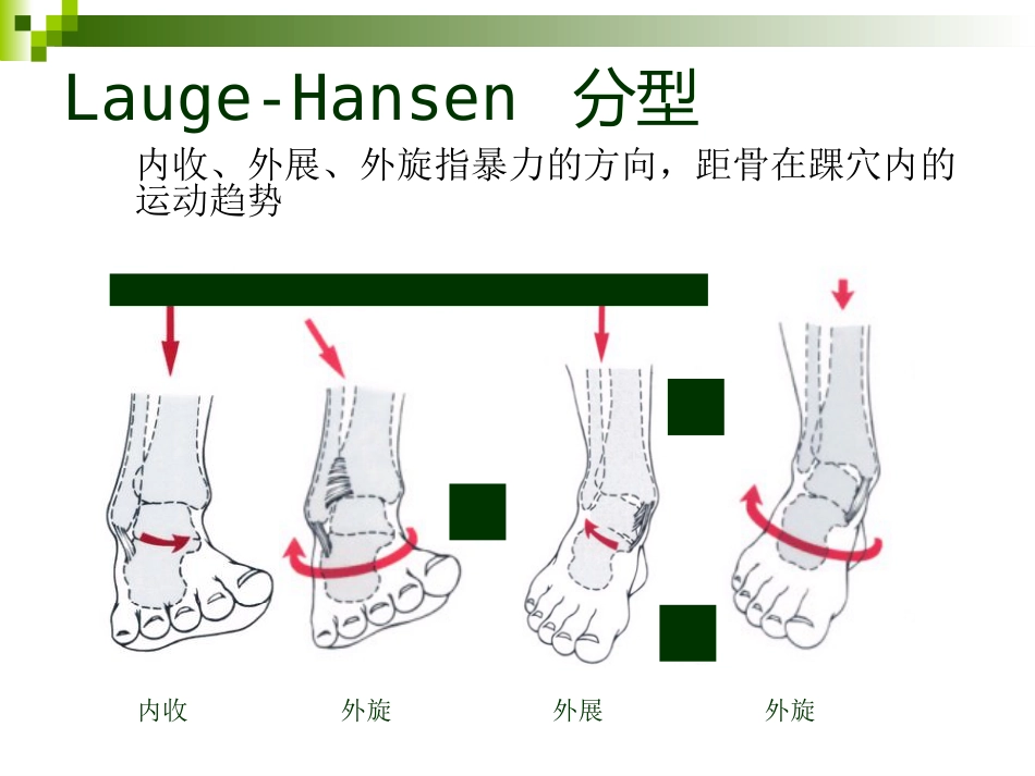 踝关节骨折的分类 和手术治疗_第5页
