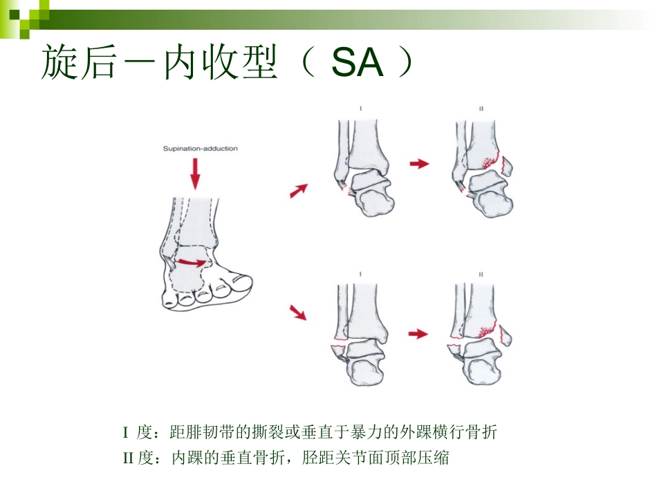 踝关节骨折的分类 和手术治疗_第6页