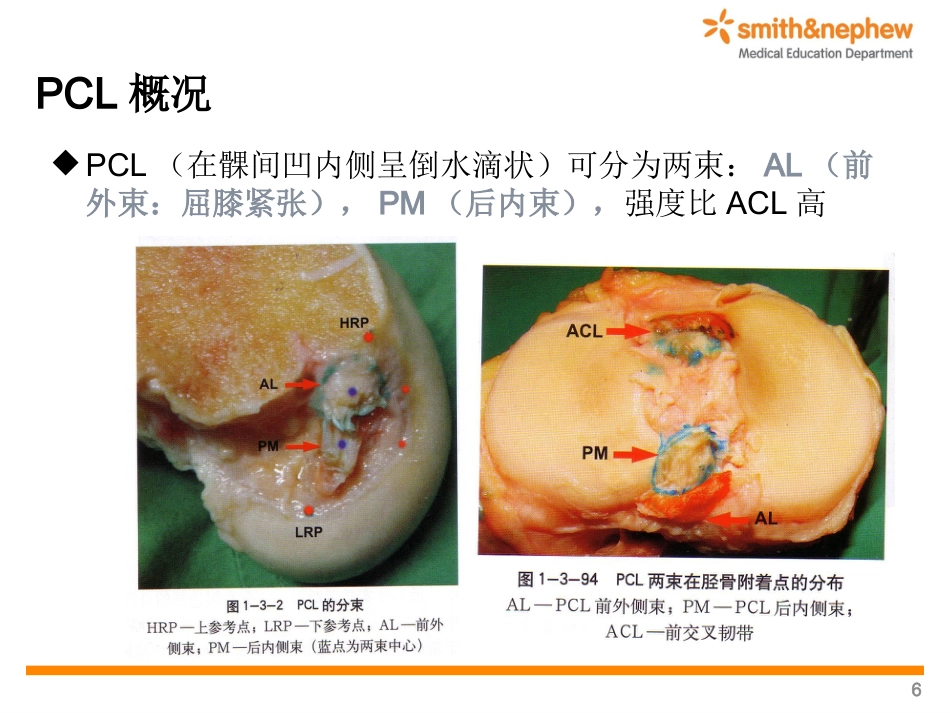 后交叉韧带重 建术_第6页