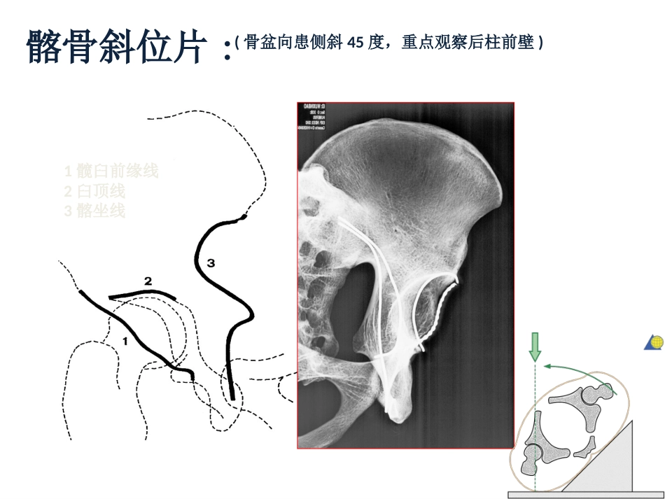 髋臼骨折基 础知识_第10页