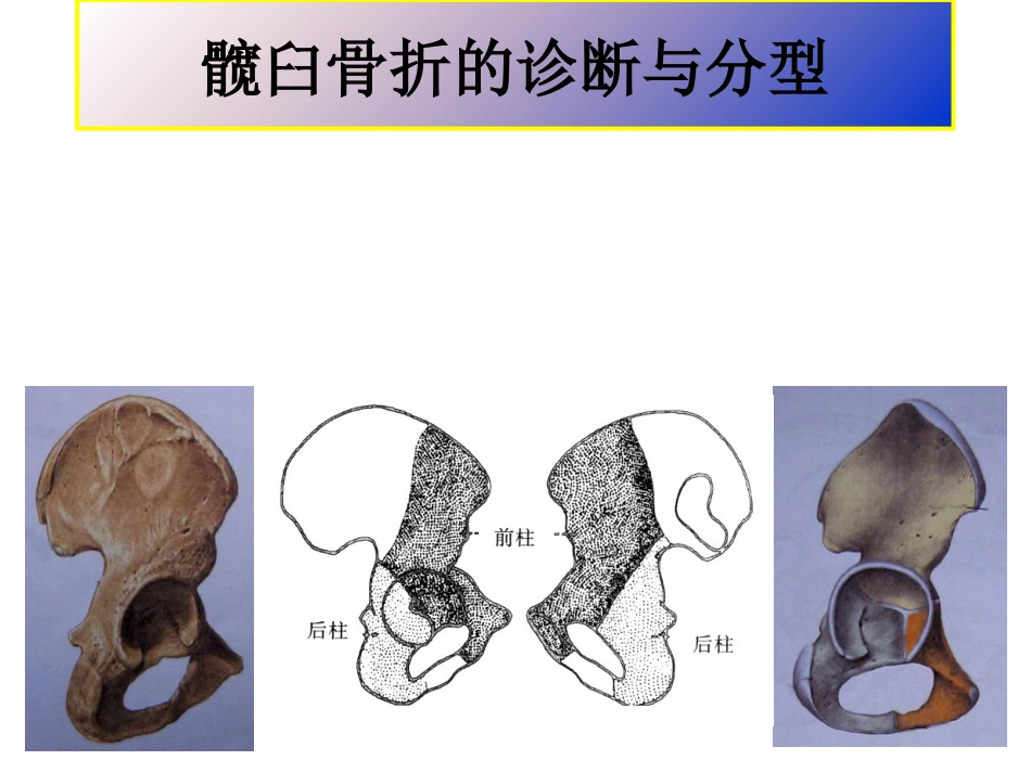 髋臼骨折基 础知识_第2页