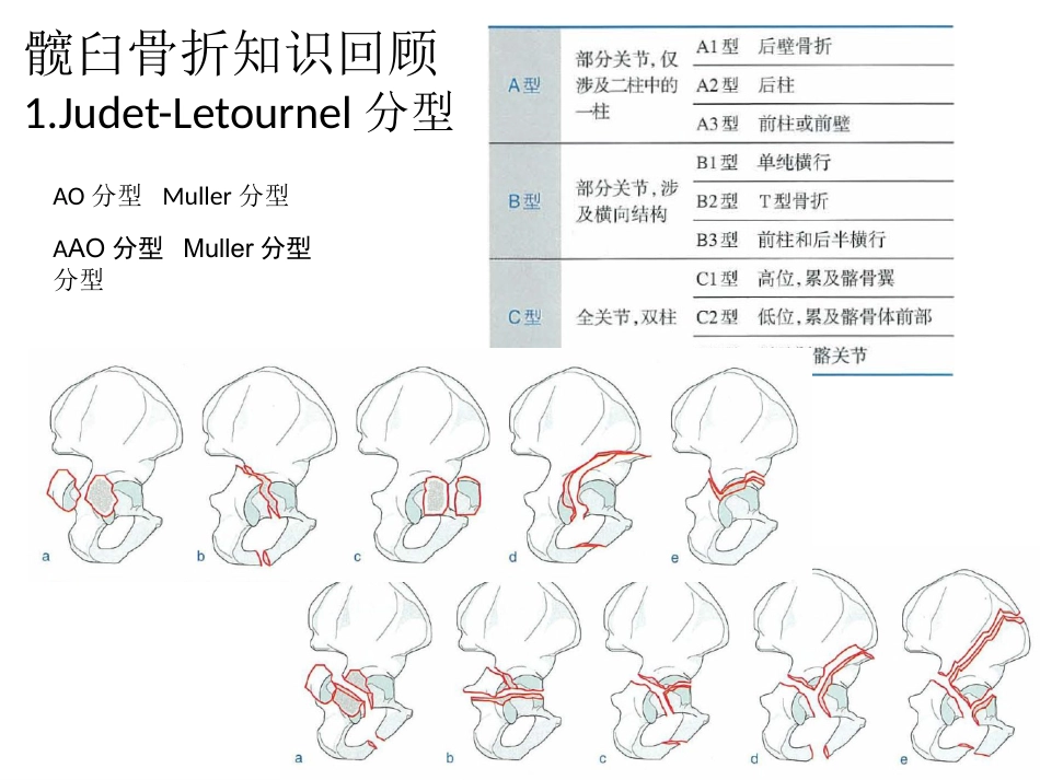髋臼骨折基 础知识_第5页