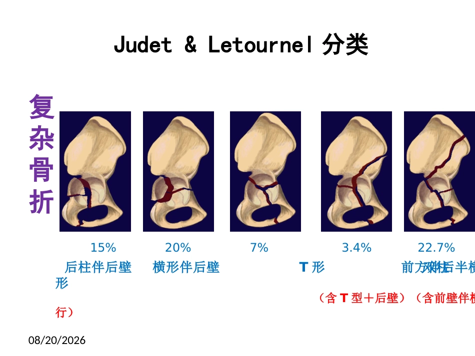髋臼骨折基 础知识_第7页