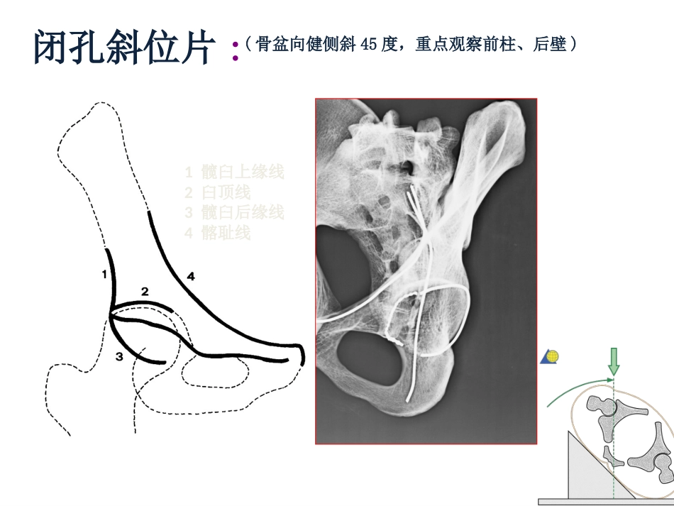 髋臼骨折基 础知识_第9页