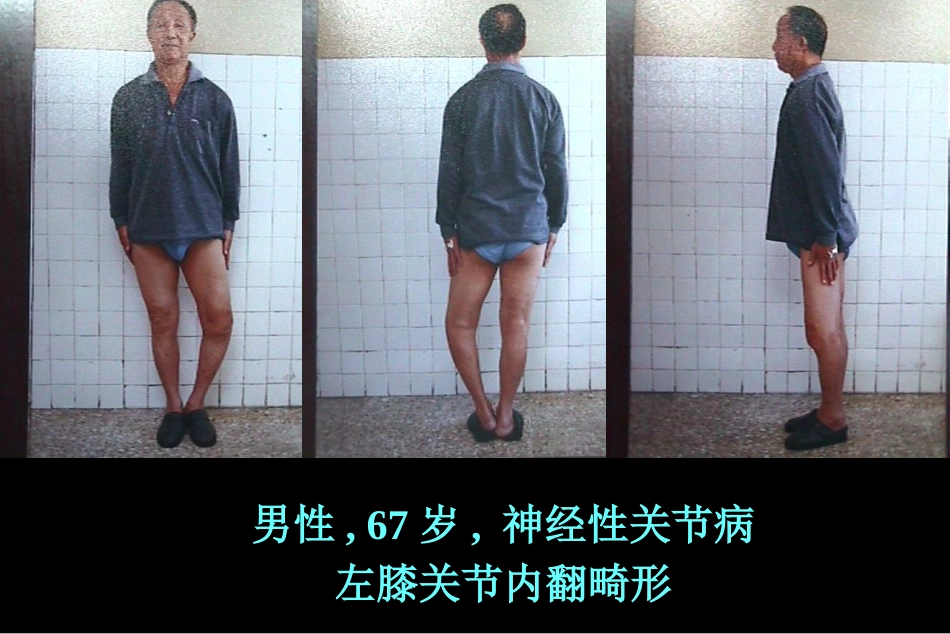 全膝关节置 换术软组织平衡_第14页