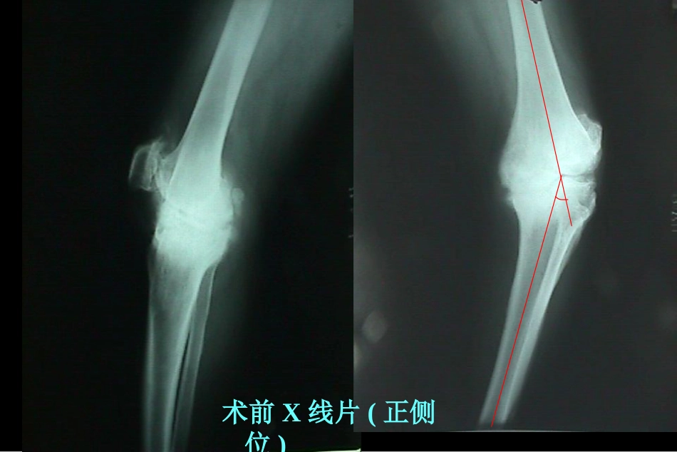 全膝关节置 换术软组织平衡_第15页