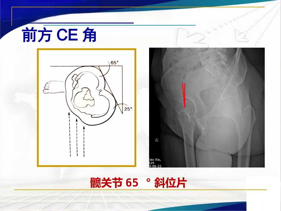 髋臼周围截骨术治疗成人髋 关节发育不良_第10页