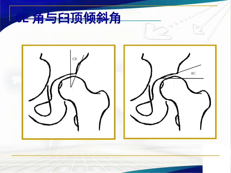 髋臼周围截骨术治疗成人髋 关节发育不良_第8页