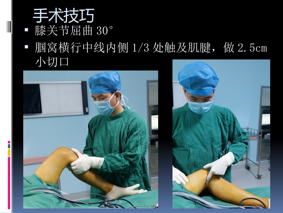 前交叉韧带重建中后侧小切口 腘绳肌腱取腱方法_第11页