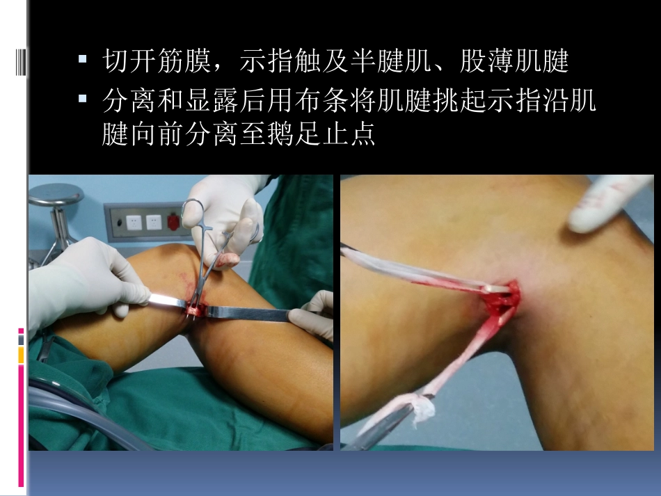 前交叉韧带重建中后侧小切口 腘绳肌腱取腱方法_第12页
