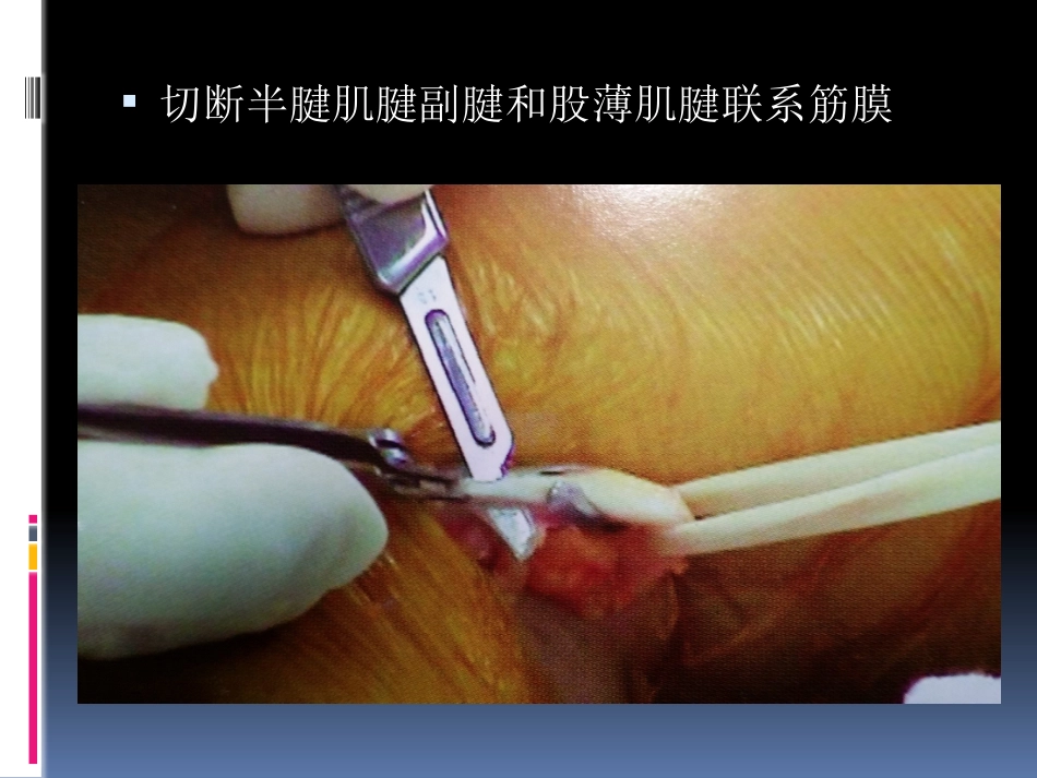 前交叉韧带重建中后侧小切口 腘绳肌腱取腱方法_第13页