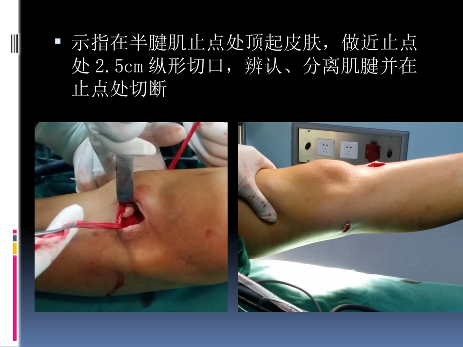 前交叉韧带重建中后侧小切口 腘绳肌腱取腱方法_第14页