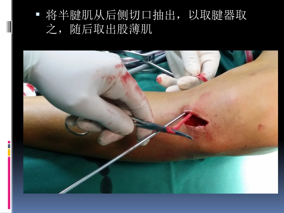 前交叉韧带重建中后侧小切口 腘绳肌腱取腱方法_第15页