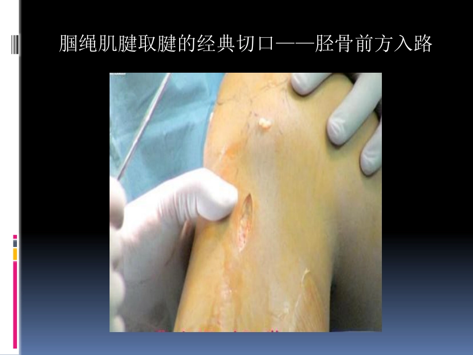前交叉韧带重建中后侧小切口 腘绳肌腱取腱方法_第3页