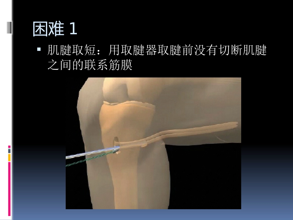前交叉韧带重建中后侧小切口 腘绳肌腱取腱方法_第5页