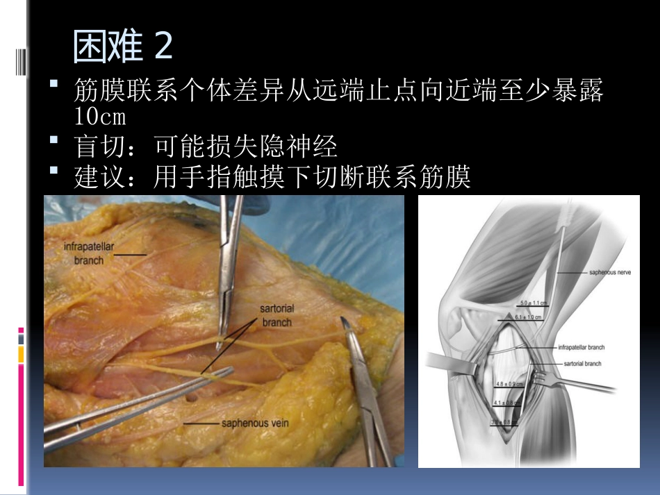 前交叉韧带重建中后侧小切口 腘绳肌腱取腱方法_第6页