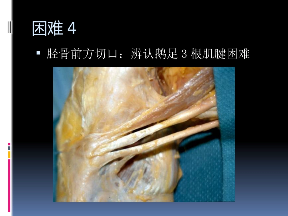 前交叉韧带重建中后侧小切口 腘绳肌腱取腱方法_第8页
