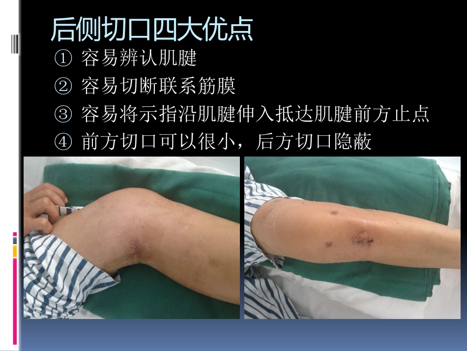 前交叉韧带重建中后侧小切口 腘绳肌腱取腱方法_第9页