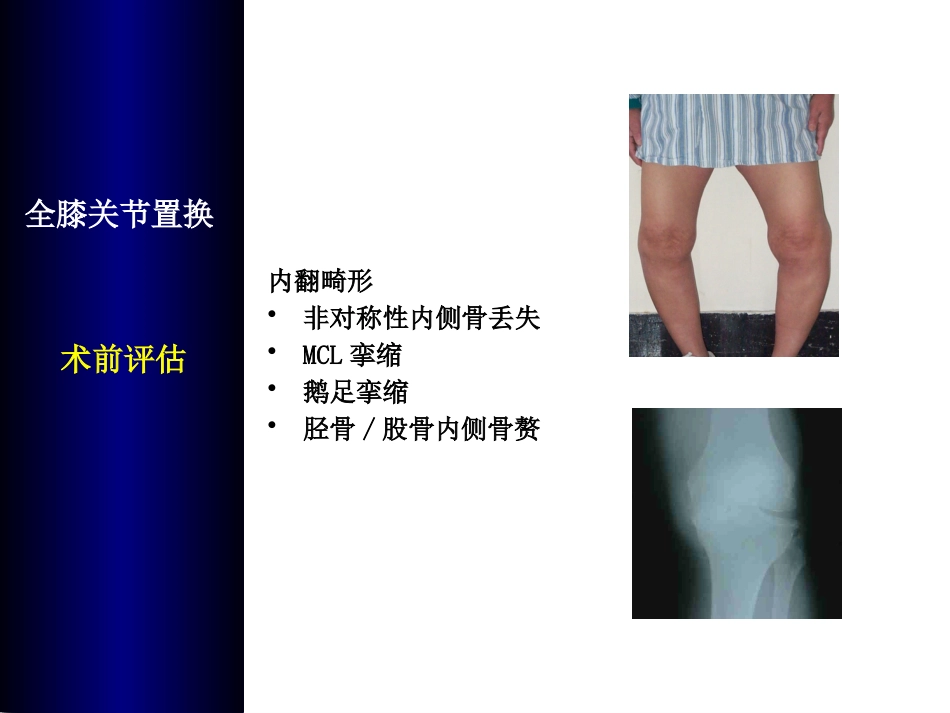 全膝关 节置换术培训_第6页