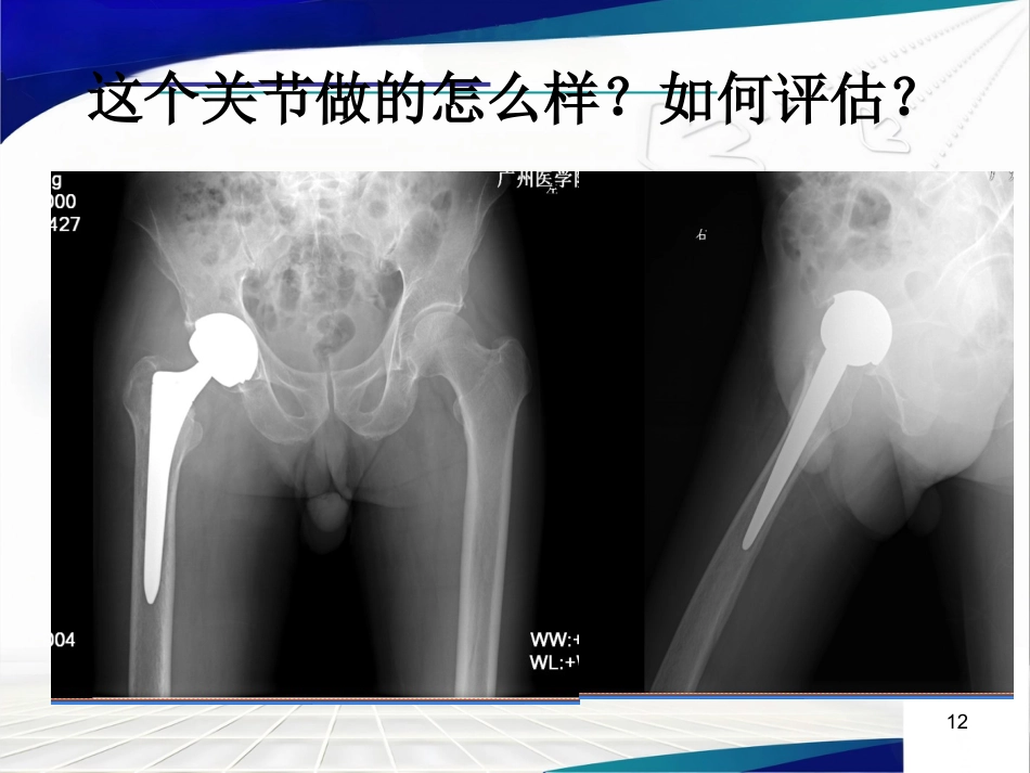 人工髋关节置 换术后的疗效评估_第12页