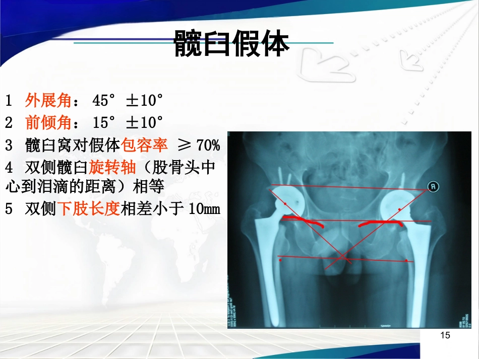 人工髋关节置 换术后的疗效评估_第15页