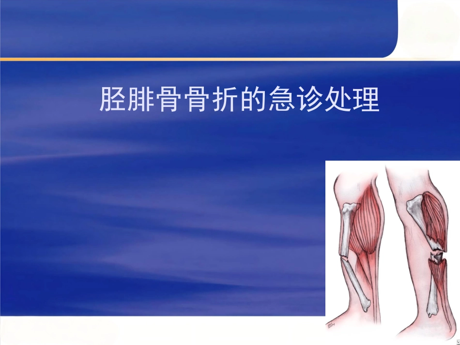 胫腓骨 骨折急诊处理_第1页