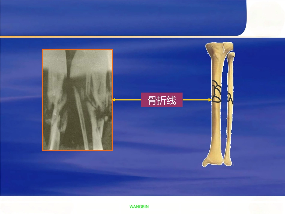 胫腓骨 骨折急诊处理_第11页