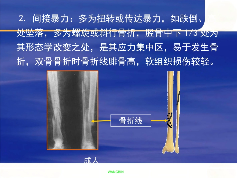 胫腓骨 骨折急诊处理_第12页
