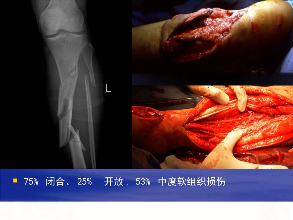 胫腓骨 骨折急诊处理_第3页