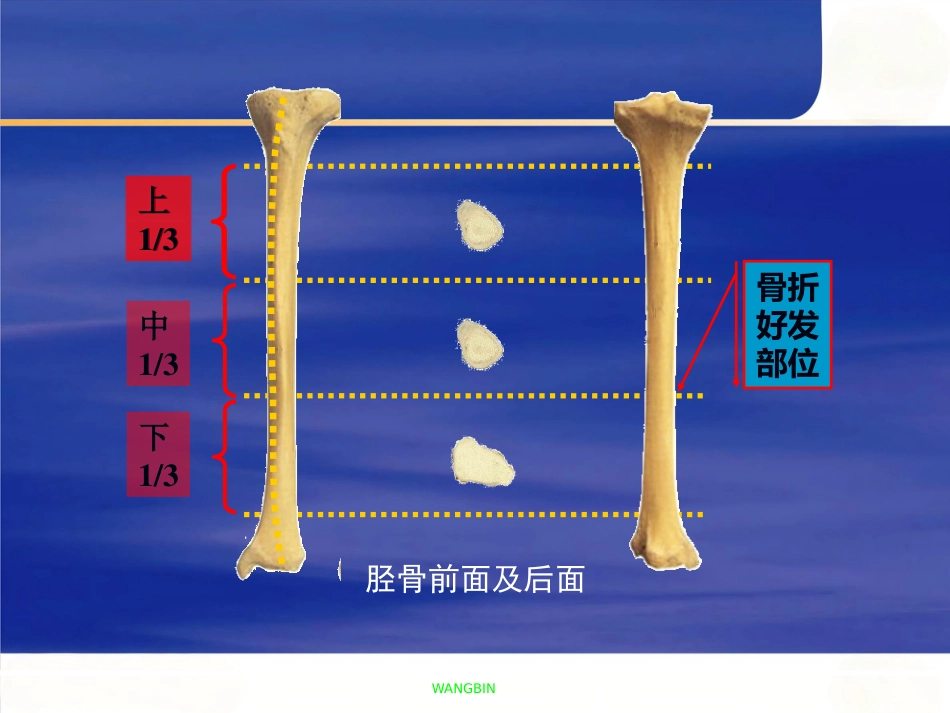 胫腓骨 骨折急诊处理_第5页