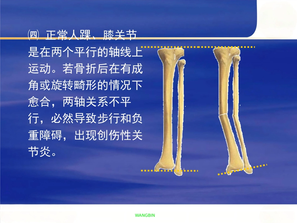 胫腓骨 骨折急诊处理_第9页