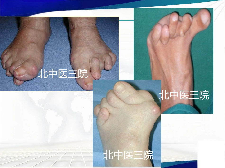 前足类风湿性 关节炎治疗_第3页