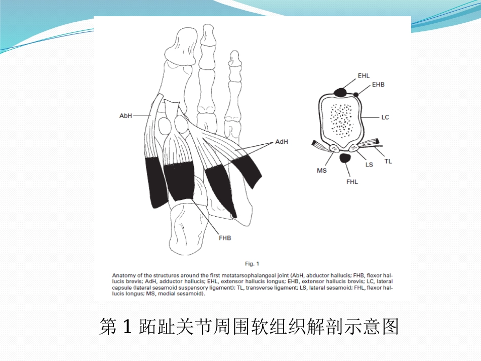 拇外翻的诊断治疗ppt_第15页