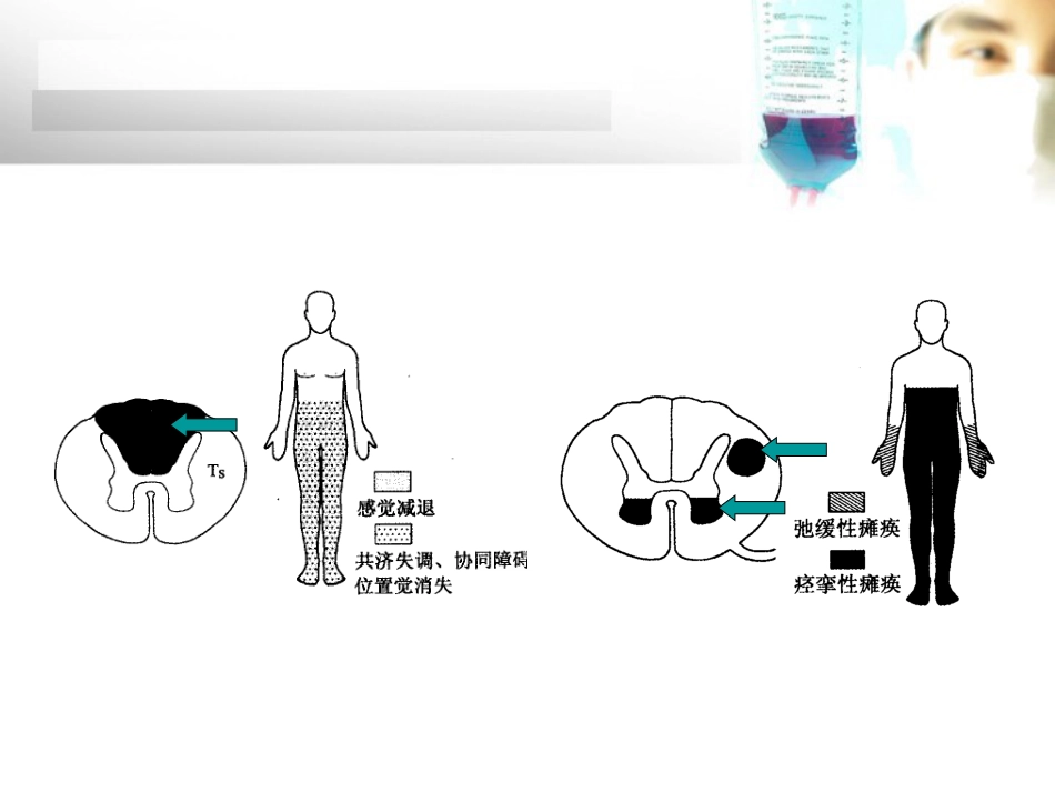 脊髓损伤的 康复_第11页