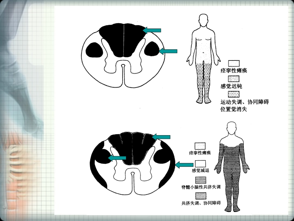 脊髓损伤的 康复_第12页