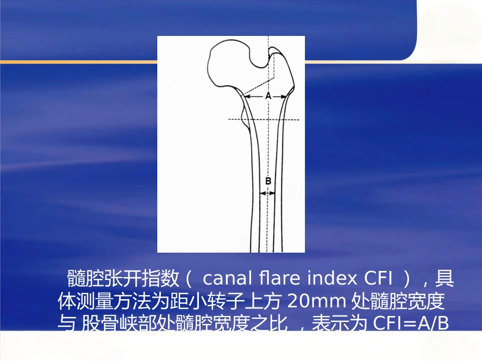 强直性脊柱炎全髋 关节置换术股骨假体的选择_第10页