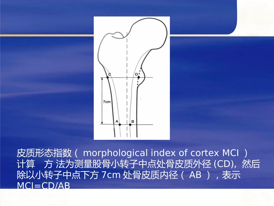 强直性脊柱炎全髋 关节置换术股骨假体的选择_第11页