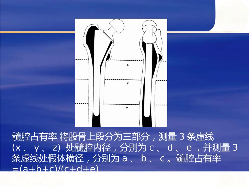 强直性脊柱炎全髋 关节置换术股骨假体的选择_第12页