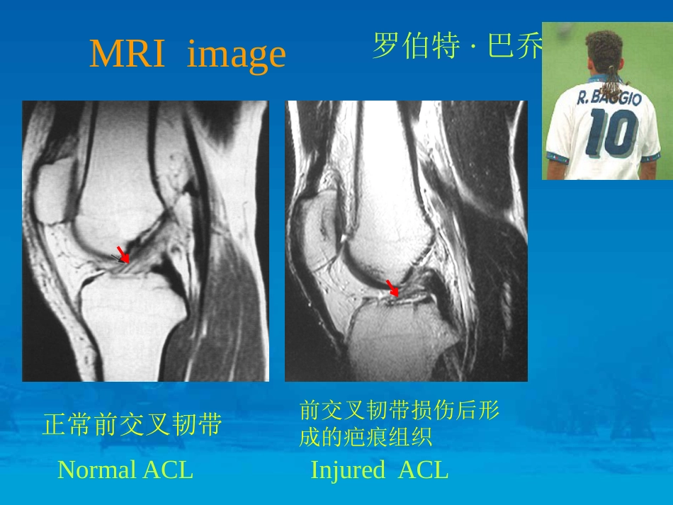 关节镜下前交 叉韧带重建术_第11页