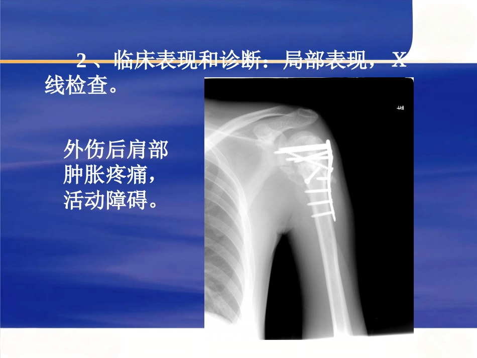 上肢骨 折_第10页