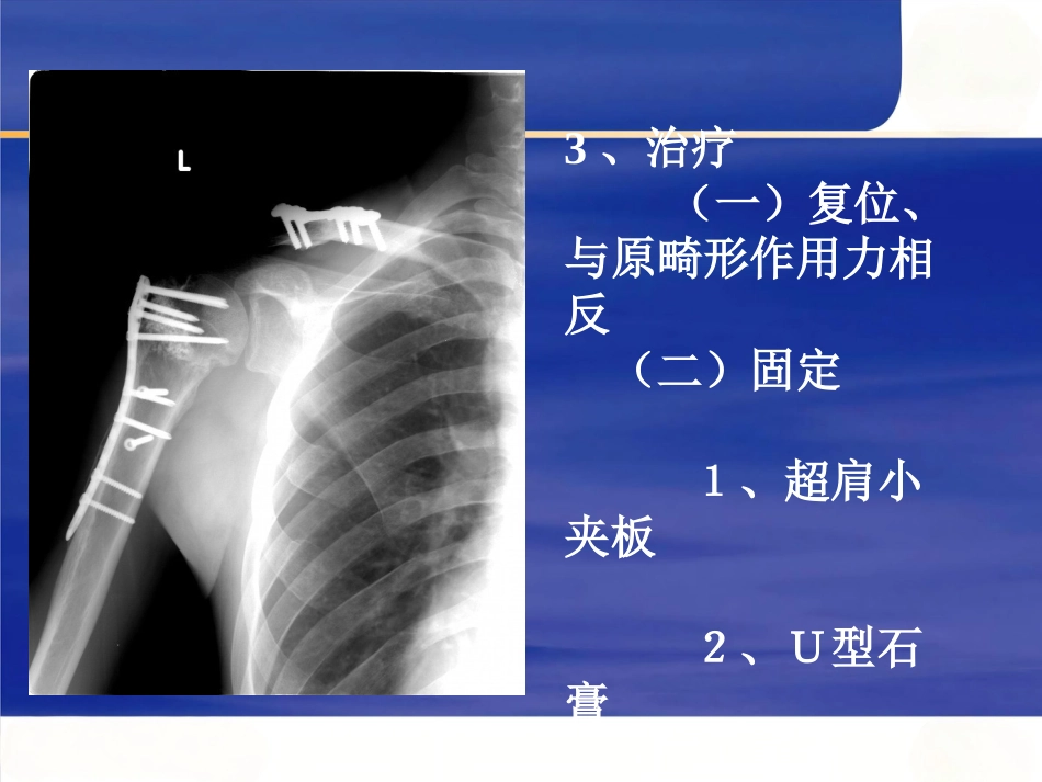 上肢骨 折_第11页
