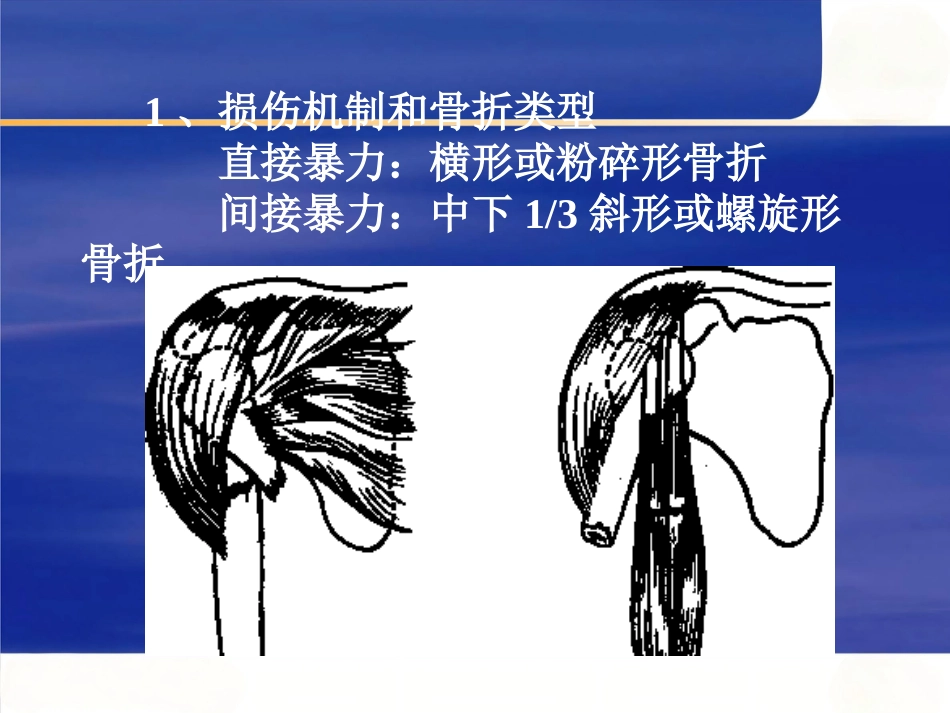 上肢骨 折_第13页
