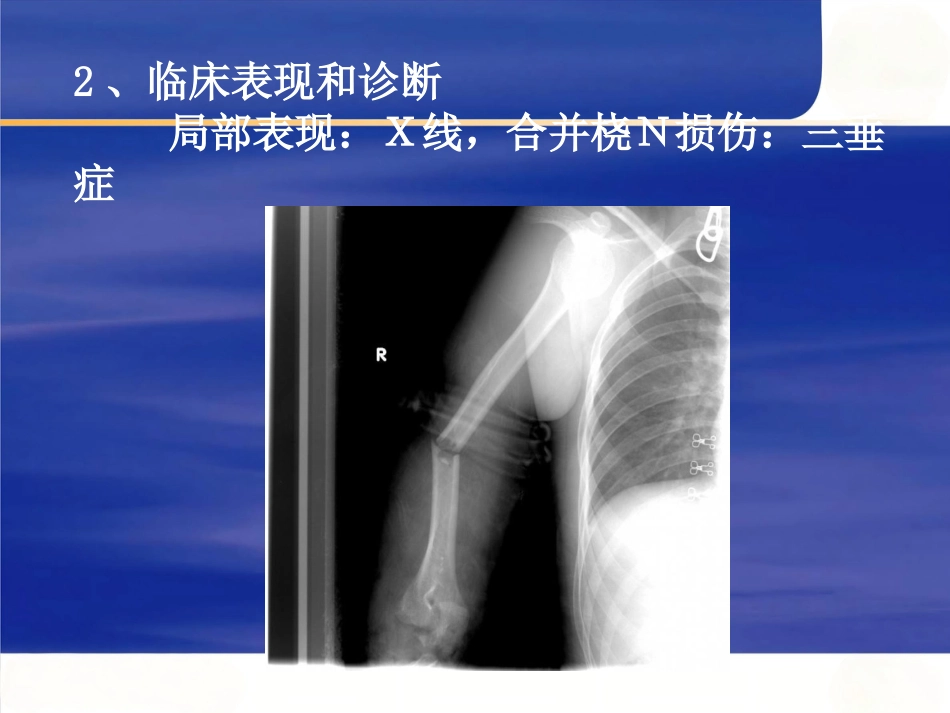 上肢骨 折_第14页