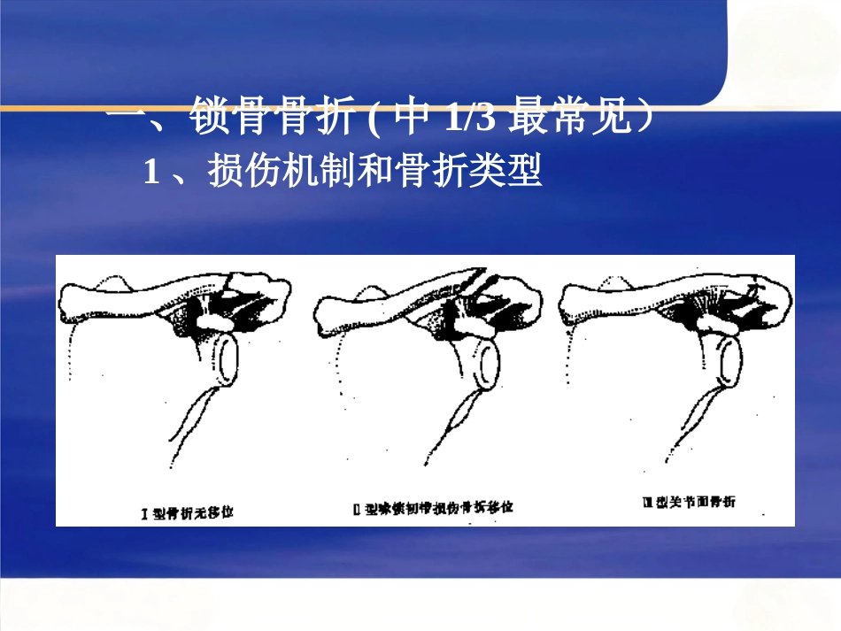上肢骨 折_第2页