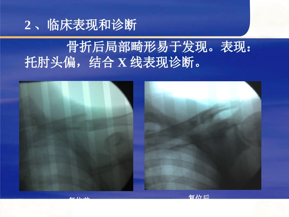上肢骨 折_第3页